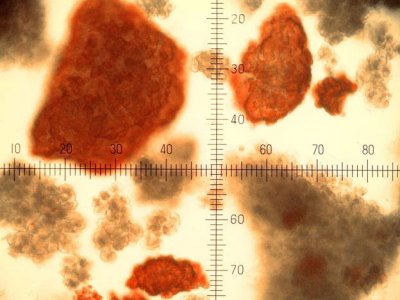 دستاوردهای جدید در درمان دیابت نوع یک با استفاده از پیوند پانکراس