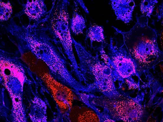 بهبود دیابت با تزریق سلولهای بنیادی مزانشیمی به بیماران