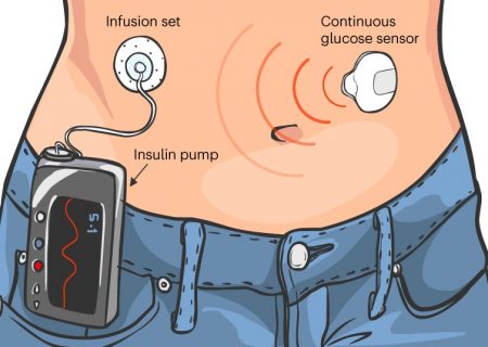 فن‌آوری جدید “لوزالمعده مصنوعی” زندگی افرادی که در مدیریت دیابت نوع ۱ مشکل دارند را تغییر می‌دهد. ​