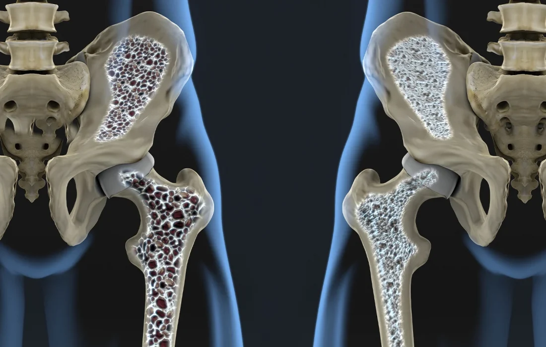 یک چهارم افراد مبتلا به دیابت در سراسر جهان دچار پوکی استخوان هستند