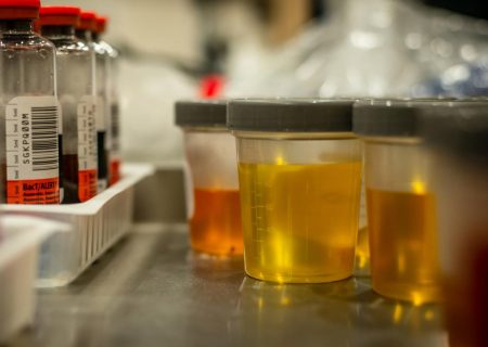 بو کردن استون در ادرار به عنوان روشی سریع برای تشخیص دیابت نوع ۲