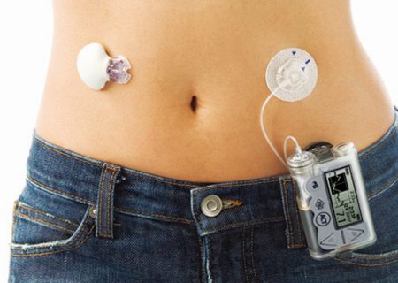 به نظر می‌رسد که سیستم حلقه بسته در کنترل گلوکز کودکان مبتلا به دیابت نوع ۱ بی خطر و برتر از مراقبت معمول باشد. ​